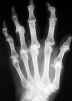 /album/a3/osteoartrose-i-png/